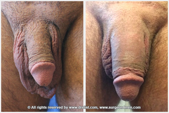 Penis Enlargement — Patient 40 — Before & After
