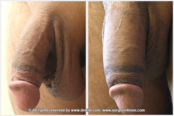 Penis Enlargement — Patient 39 — Before & After