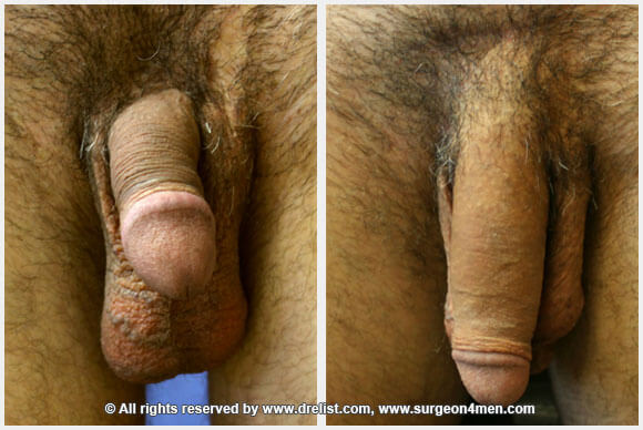 Penis Enlargement — Patient 37 — Before & After