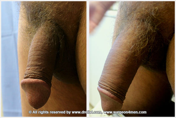 Penis Enlargement — Patient 36 — Before & After