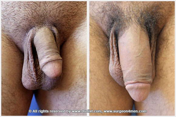 Penis Enlargement — Patient 35 — Before & After