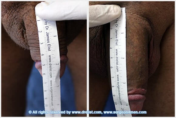 Penis Enlargement — Patient 33 — Before & After