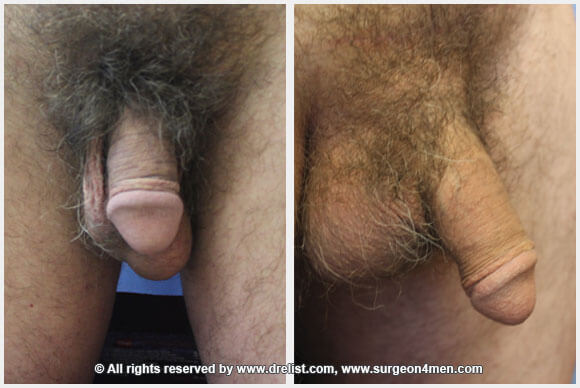Penis Enlargement — Patient 32 — Before & After