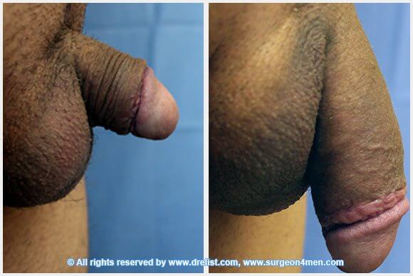 Penis Enlargement — Patient 31 — Before & After