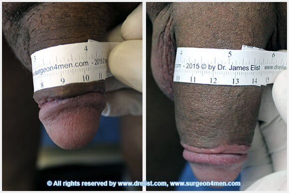 Penis Enlargement — Patient 30 — Before & After