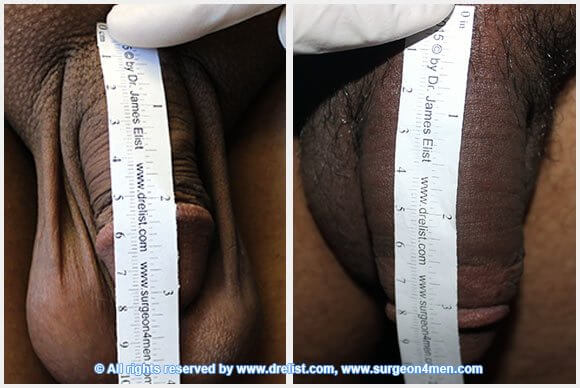 Penis Enlargement — Patient 29 — Before & After