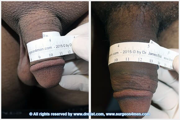 Penis Enlargement — Patient 28 — Before & After