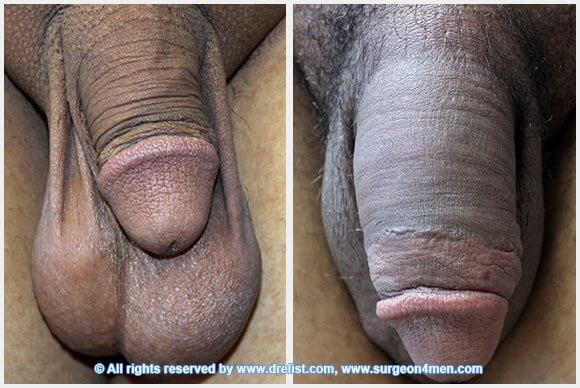 Penis Enlargement — Patient 27 — Before & After