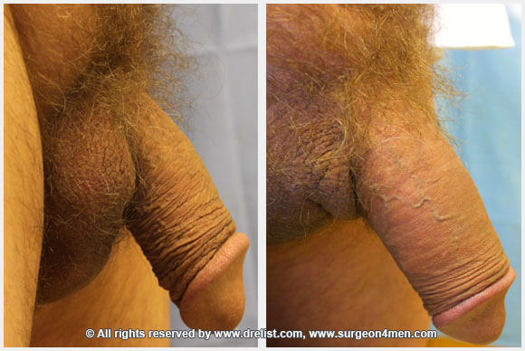 Penis Enlargement — Patient 26 — Before & After