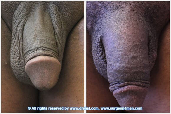 Penis Enlargement — Patient 25 — Before & After