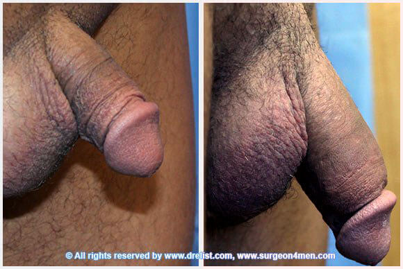 Penis Enlargement — Patient 23 — Before & After