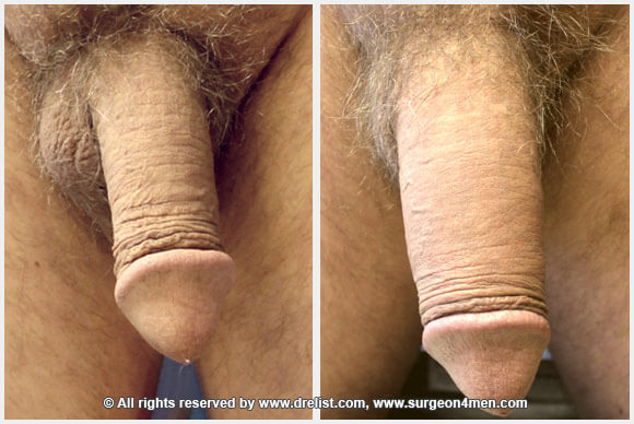Penis Enlargement — Patient 22 — Before & After
