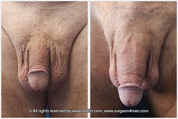 Penis Enlargement — Patient 20 — Before & After
