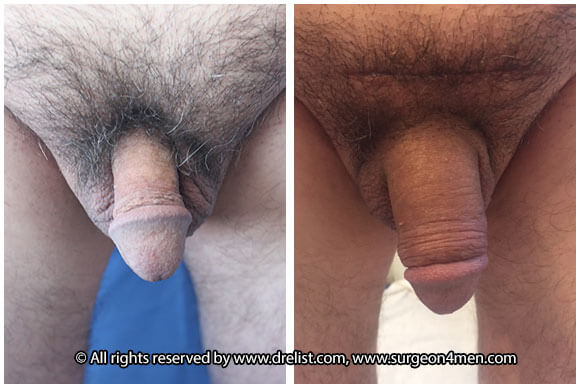 Penis Enlargement — Patient 15 — Before & After