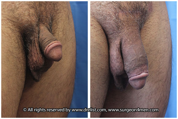 Penis Enlargement — Patient 12 — Before & After