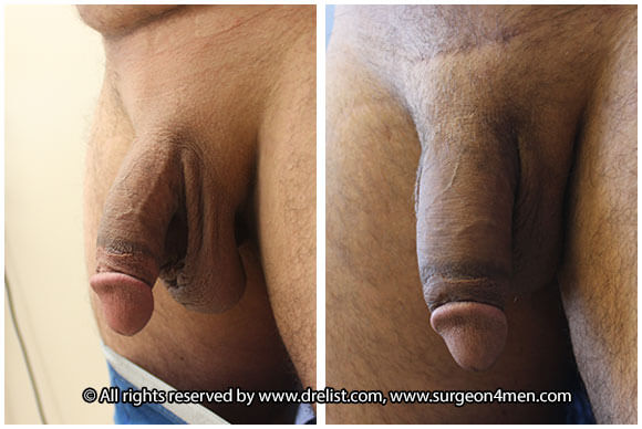 Penis Enlargement — Patient 11 — Before & After