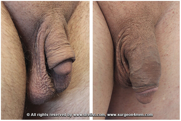 Penis Enlargement — Patient 8 — Before & After