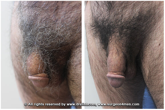 Penis Enlargement — Patient 5 — Before & After