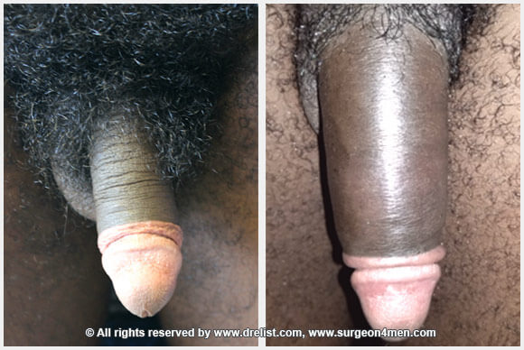 Penis Enlargement — Patient 1 — Before & After