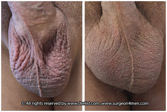 Testicular Enlargement — Patient 5 — Before & After