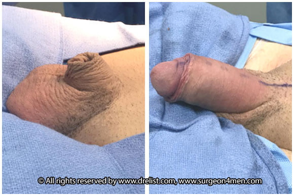 Buried Penis — Patient 5 — Before & After