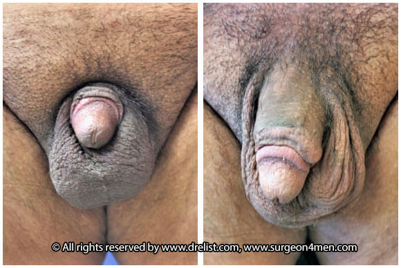 Buried Penis — Patient 2 — Before & After