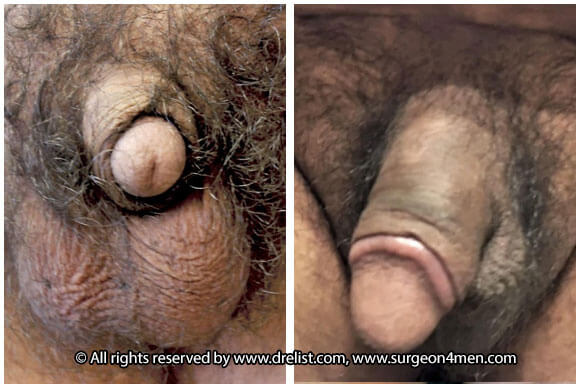 Buried Penis — Patient 1 — Before & After