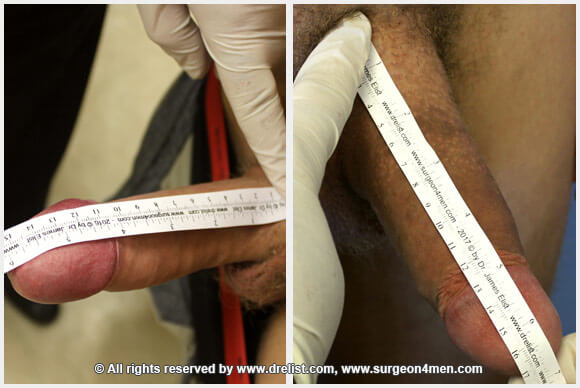 Erect Penis — Patient 8 — Before & After