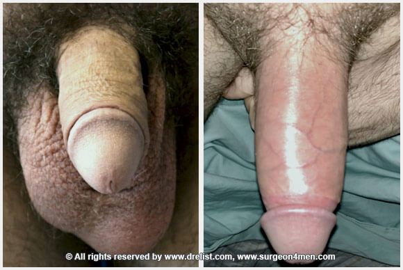 Erect Penis — Patient 4 — Before & After