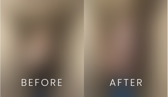 Penile Enhancement Before & After Gallery Preview (42 Cases)