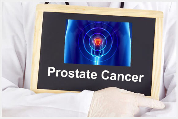Dr Elist and Prostate Cancer
