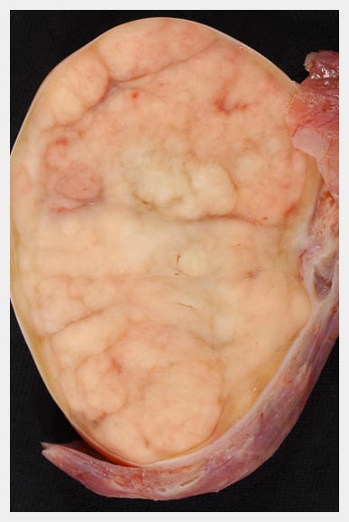 Testicular Cancer Risk Factors