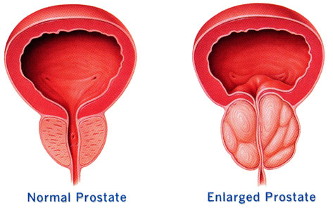 Enlarged Prostate