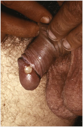 A chancroid lesion on penis