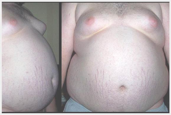 Abdominal Fat Risks