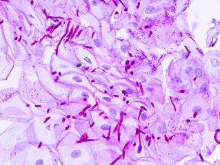 Candidiasis
