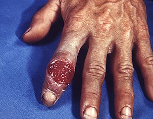 syphilis 