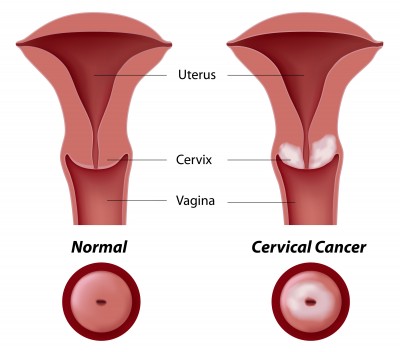 Human Papillomavirus
