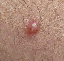 Human Papillomavirus
