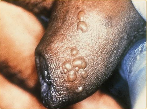 Genital Herpes Symptoms in Men
