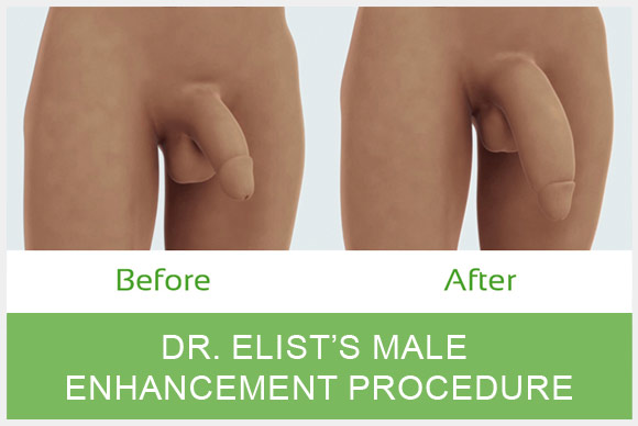 Penile Enlargement Procedure, penile enlargement experience