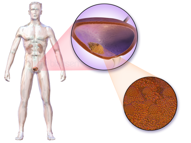 Bladder Cancer