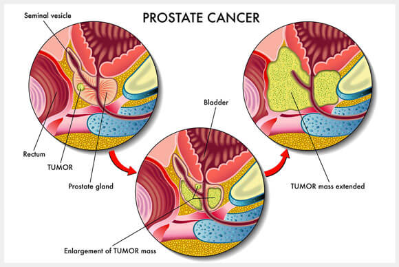 Is Prostate Cancer Screening right for you?!