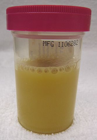 333px-Pyuria2011