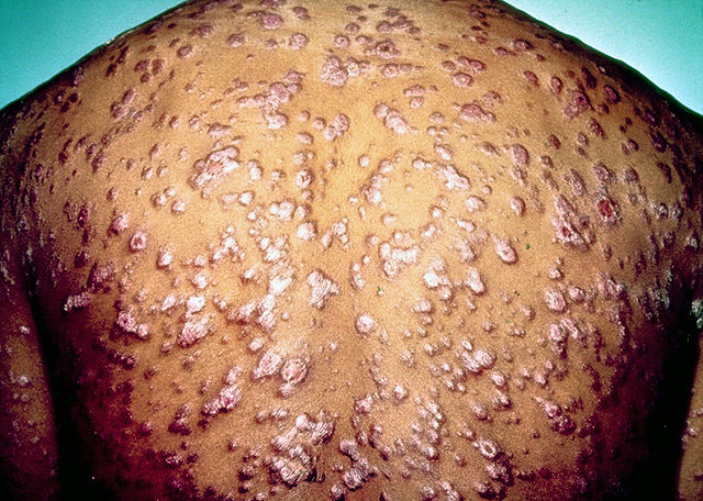 syphilis, Oral Sex STDs