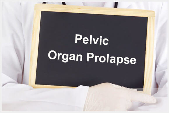 Pelvic Organ Prolapse Condition