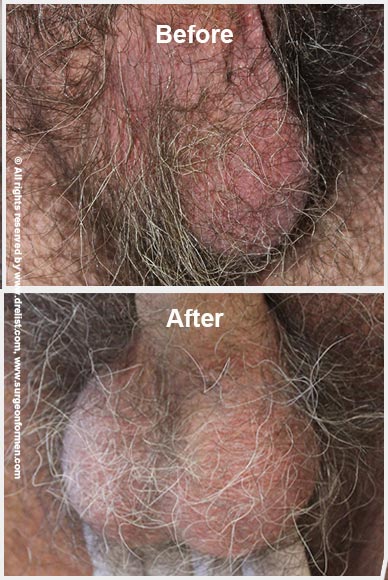 Testicle Enlargement Before After Photo