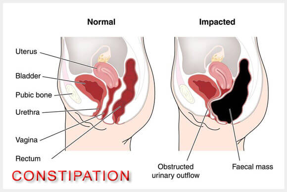 Constipation Causes and Treatment