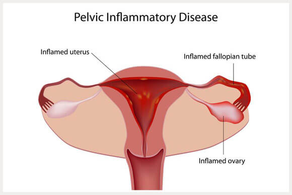 Pelvic Inflammatory Disease