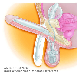 erectile-Penile Prosthesis Surgery for Erectile Dysfunction